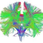 desconexiones cuarpo calloso cerebro