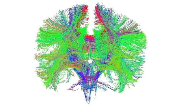 fumar cannabis de alta resistencia puede dañar las fibras nerviosas en el cerebro 130 desconexiones cuarpo calloso cerebro
